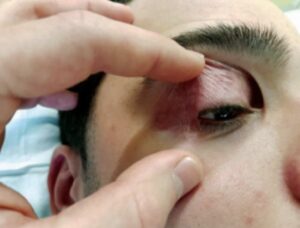 Симптомы блефарохалазиса