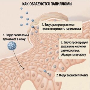 Схема как развиваются паппиломы века