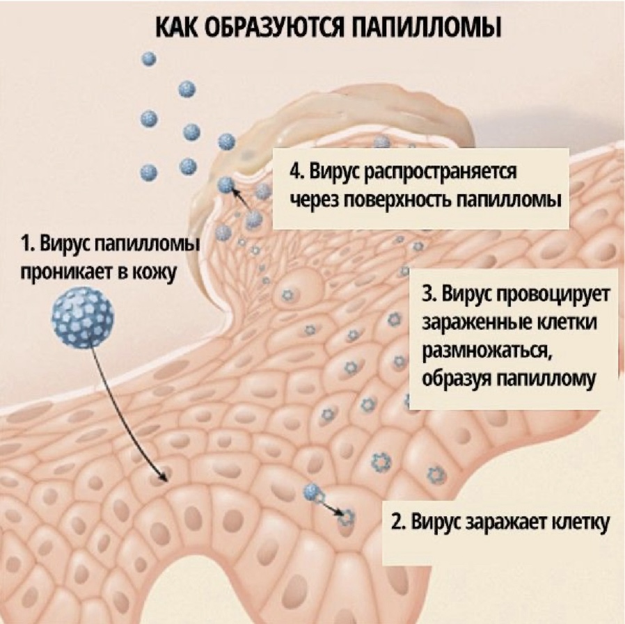 Схема как развиваются паппиломы века