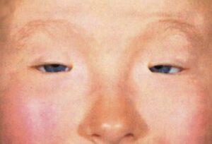 Блефарофимоз