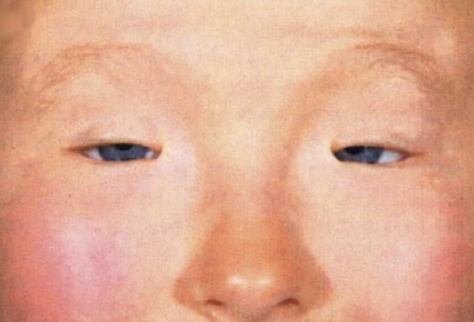 Блефарофимоз