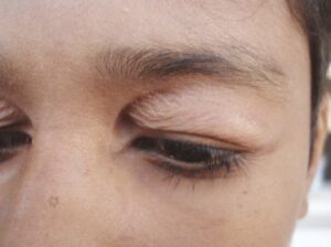 Складка псевдоэпикантальная