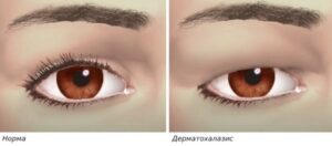 Дерматохалазис