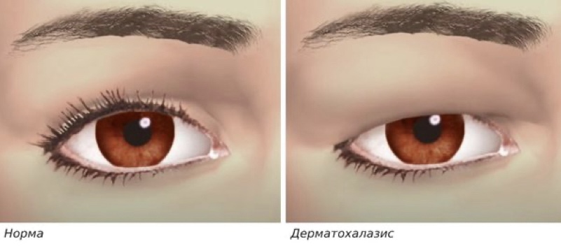 Дерматохалазис