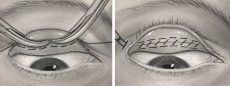 Операция Фазанелла-Серват